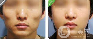 上海顴骨內(nèi)推價格是多少