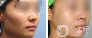 上海顴骨內(nèi)推價格是多少