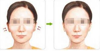 上海顴骨內(nèi)推價格是多少