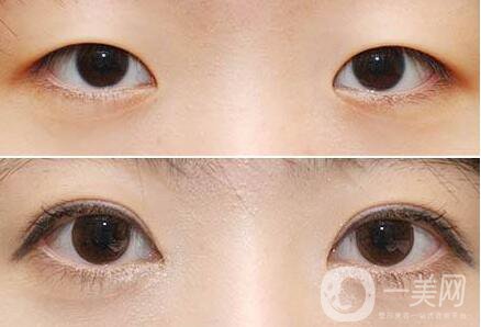 開眼角*果,開眼角注意事項