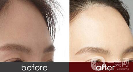 假體豐額頭維持時間是多久