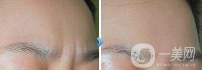 *去眉間紋維持時(shí)間是多長