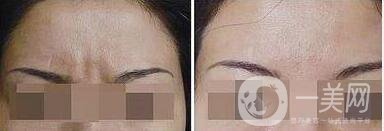 *去眉間紋維持時(shí)間是多長