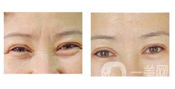*去眉間紋維持時(shí)間是多長