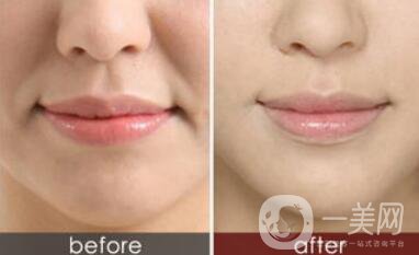 寧波手術(shù)去法令紋多少錢