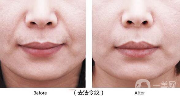 寧波手術(shù)去法令紋多少錢