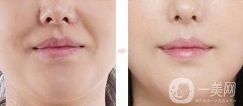 *去法令紋術(shù)后護(hù)理要怎么做