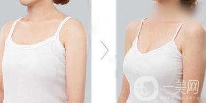 成都假體豐胸多少錢