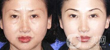 廈門做拉皮手術(shù)多少錢