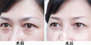 北京溶脂去眼袋價(jià)格是多少