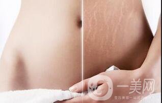 果酸換膚去妊娠紋*果,果酸換膚去妊娠紋多少錢