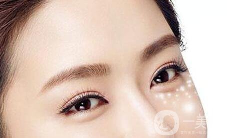 北京自體豐臥蠶多少錢,自體豐臥蠶注意事項