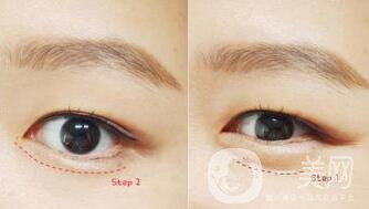 北京自體豐臥蠶多少錢,自體豐臥蠶注意事項