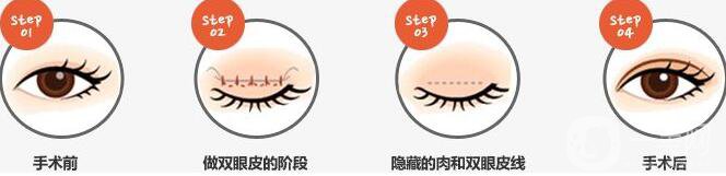 割雙眼皮埋線過程圖,埋線雙眼皮注意事項(xiàng)