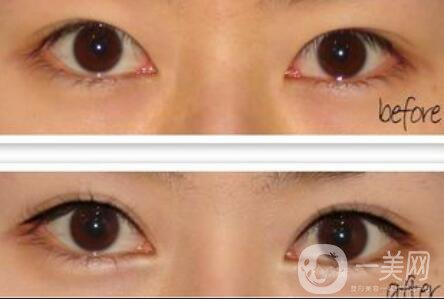 開眼角注意事項(xiàng)