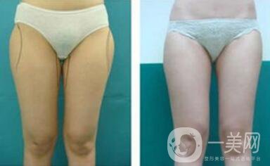 光纖溶脂瘦大腿會反彈嗎？術(shù)后注意事項(xiàng)介紹