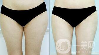 光纖溶脂瘦大腿會反彈嗎？術(shù)后注意事項(xiàng)介紹