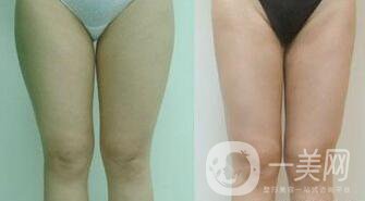光纖溶脂瘦大腿會反彈嗎？術(shù)后注意事項(xiàng)介紹