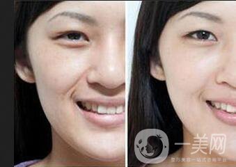 手術(shù)去法令紋*果*維持嗎