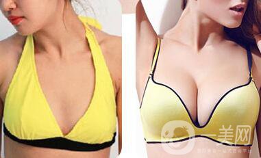 自體隆胸手術(shù)失敗修復(fù)容易嗎