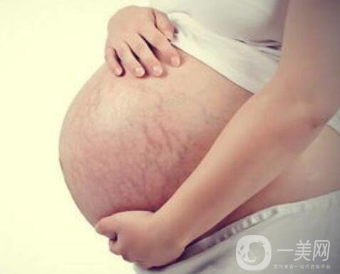 成都腹壁整形去妊娠紋多少錢,腹壁整形去妊娠紋術后護理