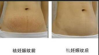 成都腹壁整形去妊娠紋多少錢,腹壁整形去妊娠紋術后護理