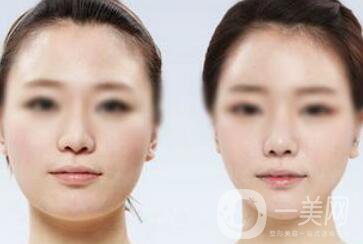 面部光纖溶脂好嗎？價格是多少