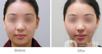 面部光纖溶脂好嗎？價格是多少