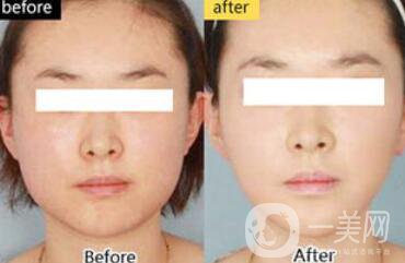 面部光纖溶脂好嗎？價格是多少