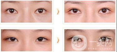 北京現(xiàn)在割雙眼皮多少錢