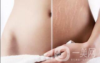 果酸換膚,去妊娠紋,果酸換膚去妊娠紋禁忌人群,果酸換膚去妊娠紋注意事項(xiàng)