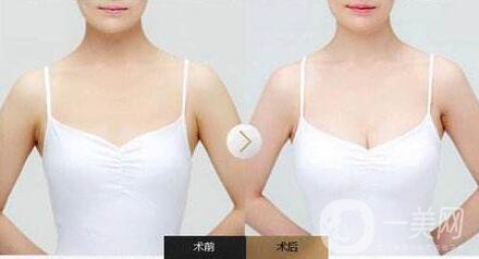 隆胸后怎么護(hù)理？術(shù)前怎么準(zhǔn)備？