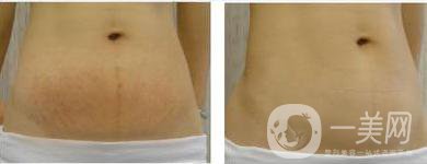 上海激光去妊娠紋手術(shù)大概多少錢