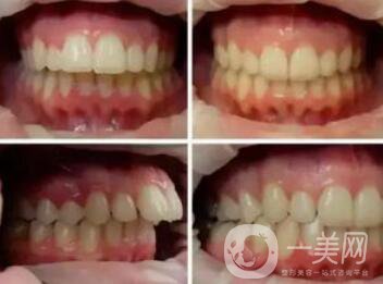 上海天包地牙齒矯正費(fèi)用是多少