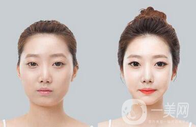 玻尿酸豐太陽(yáng)穴*果好嗎