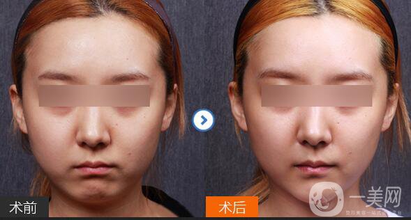 北京膨體墊下巴多少錢,膨體墊下巴注意事項