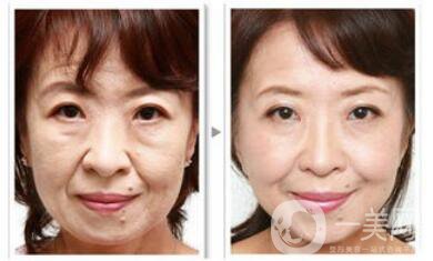 汕頭電波拉皮除皺多少錢(qián)