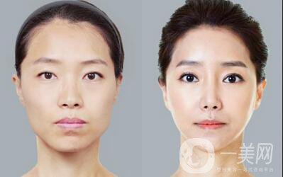 玻尿酸豐蘋(píng)果肌術(shù)后多久*果自然