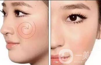 玻尿酸豐蘋(píng)果肌術(shù)后多久*果自然