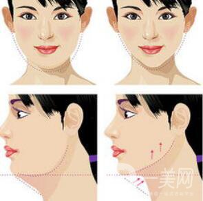 怎么去掉雙下巴？溶脂去雙下巴怎么樣