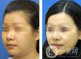 怎么去掉雙下巴？溶脂去雙下巴怎么樣