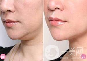 怎么去掉雙下巴？溶脂去雙下巴怎么樣
