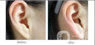 上海自體脂肪豐耳垂*果,自體脂肪豐耳垂注意事項