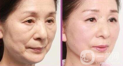 拉皮除皺能堅(jiān)持幾年？與哪些因素有關(guān)？