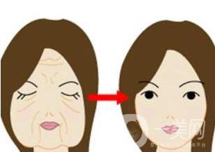 拉皮除皺能堅(jiān)持幾年？與哪些因素有關(guān)？