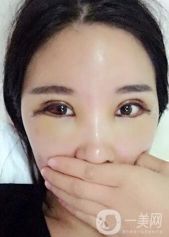 全開雙眼皮和開眼角