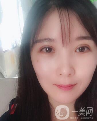 全開雙眼皮和開眼角