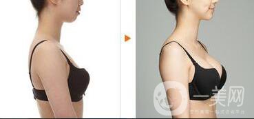 假體隆胸材料有哪些？*果怎么樣