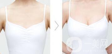 假體隆胸材料有哪些？*果怎么樣