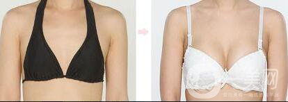 假體隆胸材料有哪些？*果怎么樣